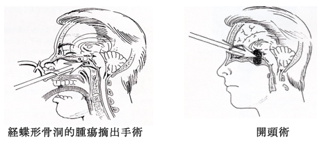 下 垂体 腫瘍 名医