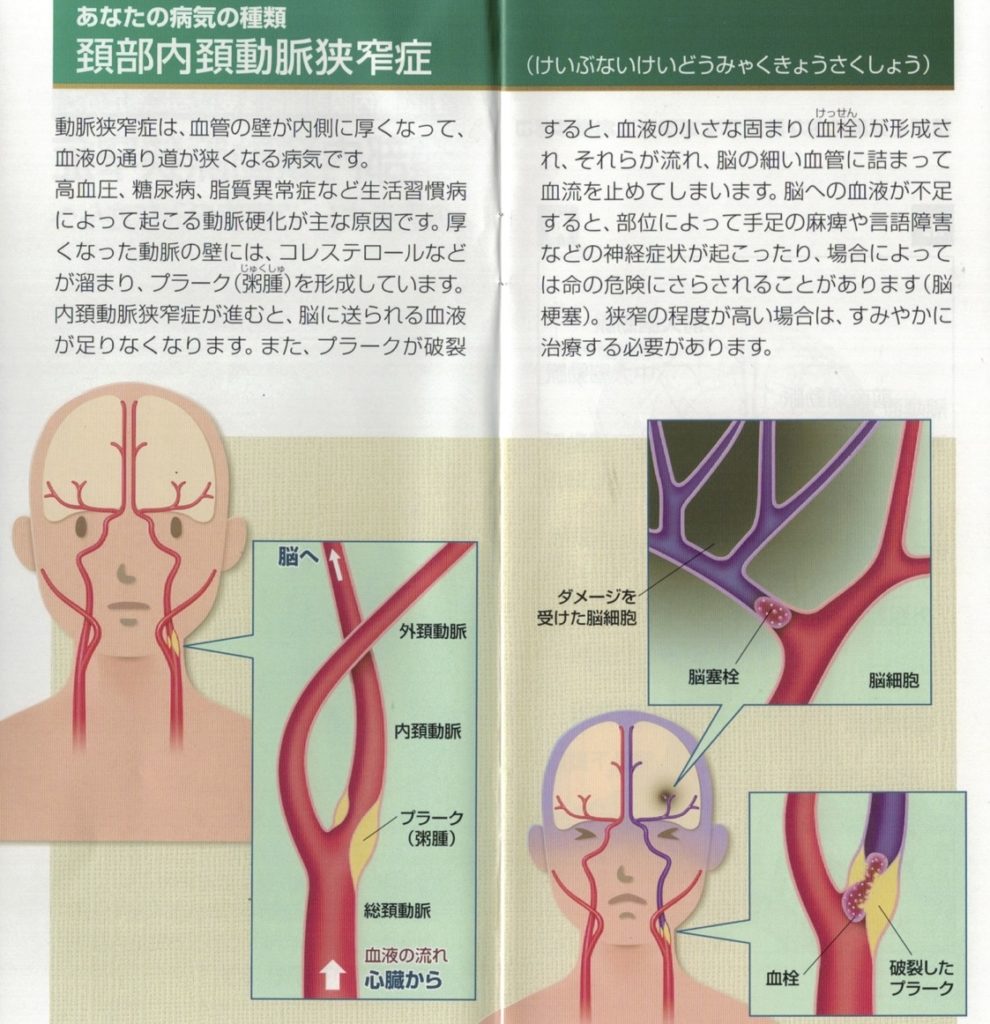 頚動脈 エコー 検査 結果 の 見方