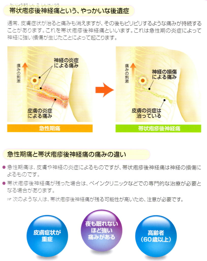 帯状 疱疹 治る まで