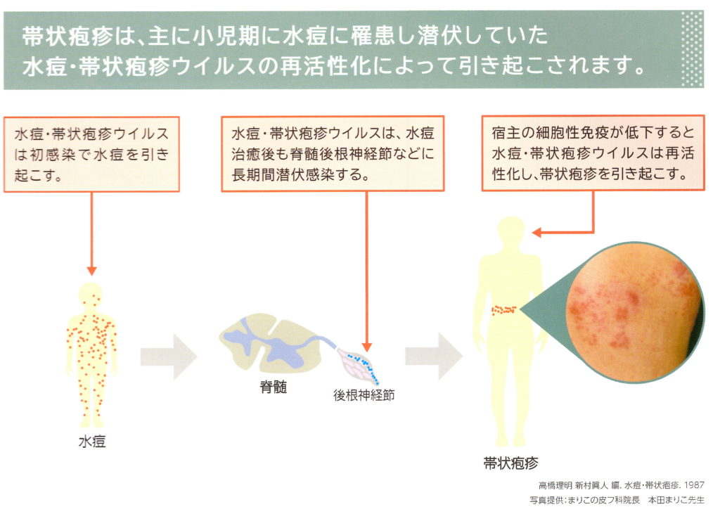 帯状 疱疹 妊娠 中